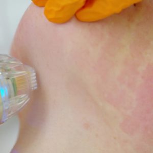 Close-up of treatment on the face by a device | Medical Level Aesthetician Courses | La Vida Laser & Aesthetics Institute